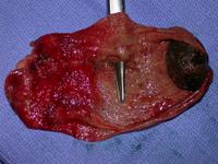 Perforated Gallbladder